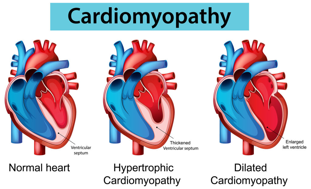 Heart Health in Duchenne Muscular Dystrophy: Cardiomyopathy, Detection, and Modern Treatment Strategies