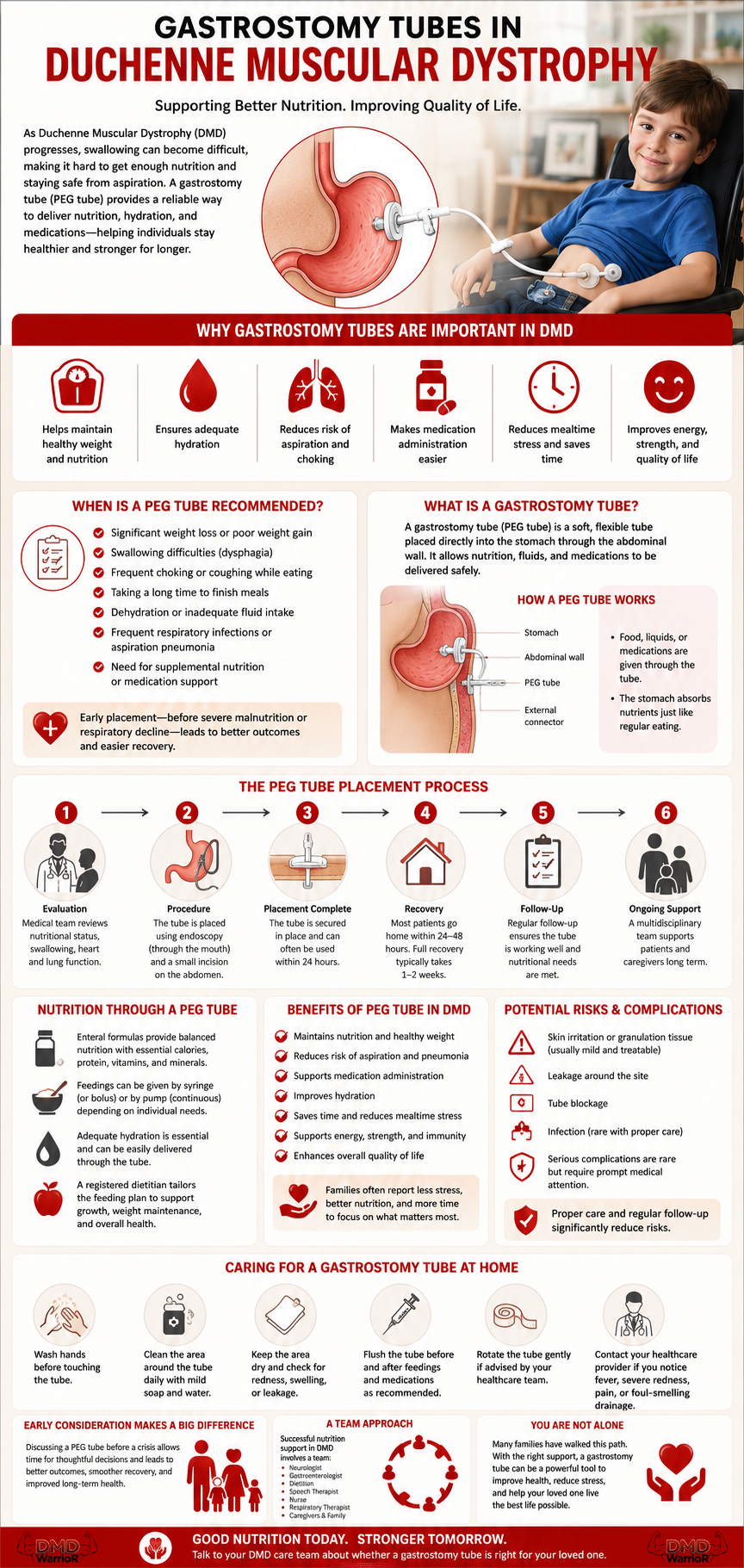 Detailed infographic explaining gastrostomy tubes in Duchenne muscular dystrophy (DMD), including PEG tube placement, nutrition support, benefits, risks, home care, and recovery.